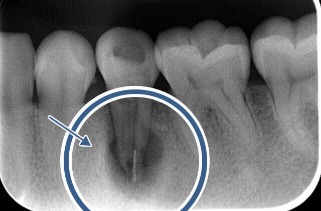 治療前のX線写真