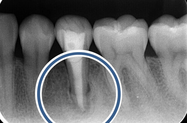 治療後のX線写真