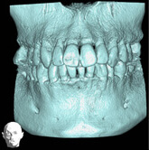 レントゲン写真