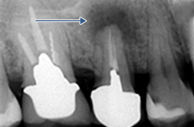 初診時レントゲン