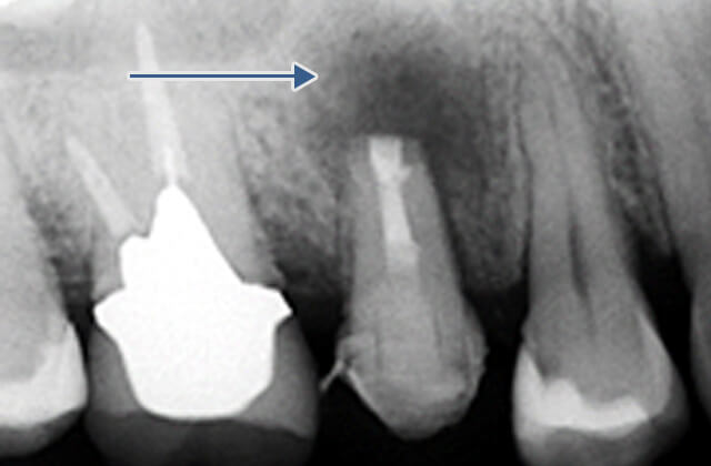 エンドサージェリー直後