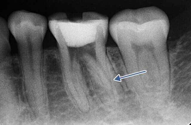 レントゲン画像