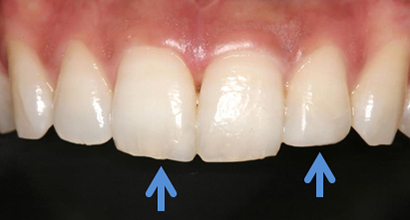 ダイレクトボンディング治療後