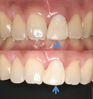 前歯の審美障害