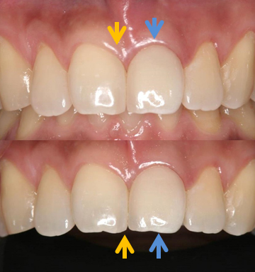 根管治療後、隣の歯にダイレクトボンディングを施す