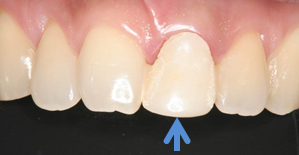 仮歯を新しく作ります