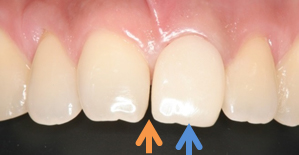 隣の歯と同じ形・大きさの仮歯