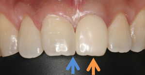 隣の歯にダイレクトボンディング