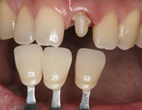 元々の歯の色を調べます
