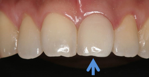 セラミックによる被せ物