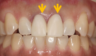 真ん中前歯２本を