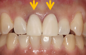 真ん中前歯２本