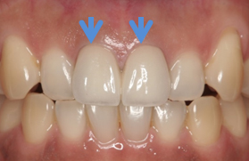 周囲の歯に調和させた被せ物