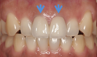 周囲の歯に調和させた被せ物