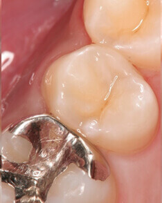 ダイレクトボンディング