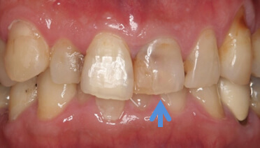 前歯の形と色の相談