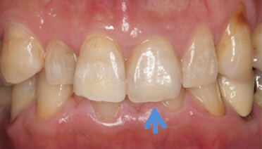 自然な前歯の形と色に満足
