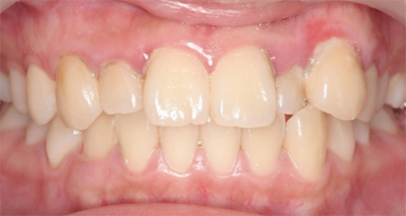 口臭と歯の着色