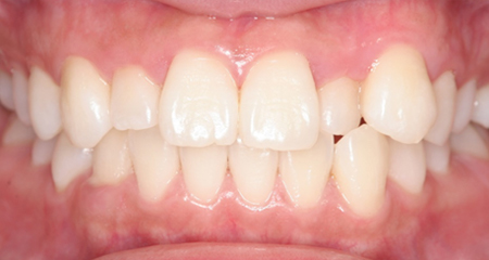 ホワイトニングの施術後