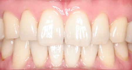 ホワイトニングの施術後