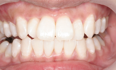 ホワイトニングの施術後