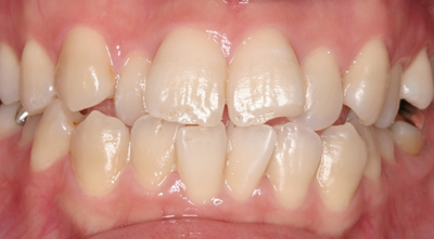 ホワイトニングを希望