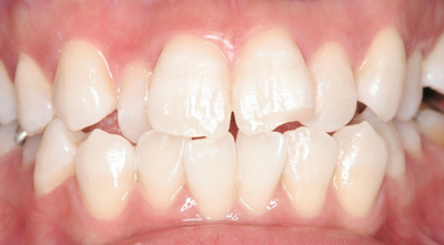 ホワイトニングの施術後