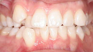 ホワイトニングの施術後