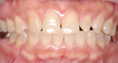 歯質の色を明るく