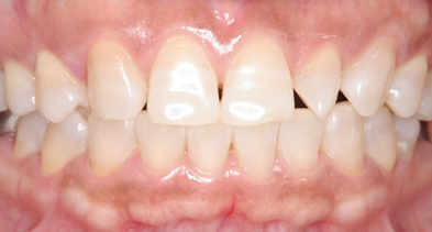 ホワイトニングの施術後