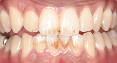 クリーニングとホワイトニング