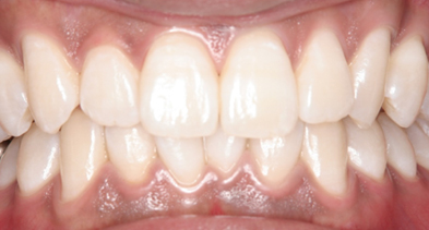 ホワイトニングの施術後